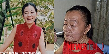 【서울=뉴시스】태국 출신의 응옌 디 푸용(26·여)은 노화가 급속도로 진행되면서 3년 만에 피부의 60~70%가 70대 할머니와 같은 상태가 됐다.(사진 출처 : 아시아원닷컴 홈페이지)