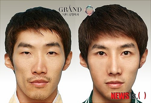 【서울=뉴시스헬스/뉴시스】 코성형 전후 사례. (사진=그랜드성형외과 제공) 조진성기자 cjs@newsishealth.com