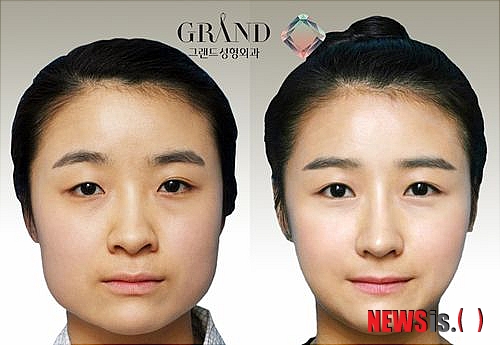 【서울=뉴시스헬스/뉴시스】 'V라인 사각턱수술' 전후 사례. (사진=그랜드성형외과 제공) 조진성기자 cjs@newsishealth.com
