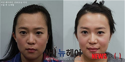 【서울=뉴시스헬스/뉴시스】 헤어라인 교정 전후 사례. (사진=NHI 뉴헤어 헤어라인 교정센터 제공) 조진성기자 cjs@newsishealth.com