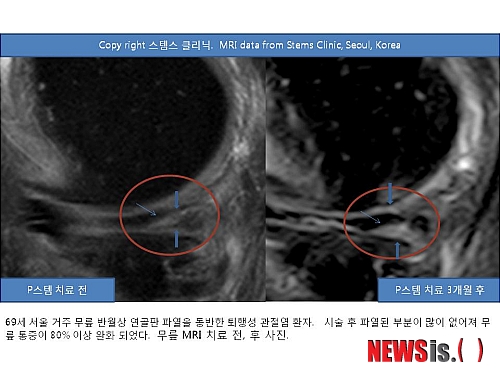 【서울=뉴시스】김정환 기자 = 자신의 세포와 혈장을 이용, 손상된 무릎 관절의 연골을 재생시키는 ‘재생세포 치료법’의 임상효과가 입증됐다.&nbsp; 서울 청담동 스템스 관절 클리닉 박재우 박사는 “관절 내시경 수술 후유증을 염려한 반월상 연골판 연골파열 환자와 퇴행성 관절염 환자가 재생 세포주사와 PRP(혈소판 풍부혈장) 치료를 받았다. 4주가 지나자 통증 등의 증상이 크게 완화됐고, 약 12주가 흐르면서 MRI(자기공명영상) 상으로도 반월상 연골판 연골이 많이 재생된 것으로 나타났다. 퇴행성 관절염 연골재생 결과는 영국 학술지(The Journal of Medical Case Reports http://www.jmedicalcasereports.com/content/5/1/296)에 발표했다”고 밝혔다.&nbsp; 무릎 반월상 연골판 연골 파열은 젊은 연령대에서는 무리한 운동이나 외상, 중장년층에서는 퇴행성 관절염 때문에 점차 흔해지고 있다. 부상 이후 무릎 관절이 지속적으로 아프다면 반월상 연골판 연골 파열을 의심해야 한다.&nbsp; 반월상 연골판은 무릎 관절의 안쪽과 바깥쪽에 1개씩 한 쌍으로 자리잡고 있다. 초승달처럼 생겨서 반월상이라고 부른다. 무릎 관절에 가해지는 충격을 흡수하는 쿠션 구실을 하며 관절뼈와 연골을 보호하고, 관절의 윤활 기능 등도 담당한다.&nbsp; 반월상 연골판 연골이 파열되면 관절 내시경 수술로 손상된 부위을 절제, 제거해 통증 원인을 치료하는 것이 최선이었다. 하지만 연골제거 수술 부작용으로 퇴행성 관절염을 조기에 초래할 수 있고 또 연골 연화증도 우려된다. 반월상 연골판 제거 수술이 후 가끔 통증이 지속되는 경우가 있는데, 이 두가지가 원인일 수도 있다.&nbsp; 신종 재생세포 치료법은 손상된 연골 조직을 직접 재생시켜 근본적으로 치료한다. 복부지방에서 추출한 치유 재생세포를 혈액 속의 PRP와 함께 환부에 주사, 연골세포 조직의 재생을 유도하는 원리다.&nbsp; 박 박사는 “내 몸의 세포를 자가 PRP와 같이 사용하기 때문에 면역적인 거부 반응이 없을뿐더러 직접 환부에서 치유 재생세포가 연골 모세포로 분화해 손상된 관절의 연골조직을 재생하므로 기존의 제거수술보다 훨씬 부담도 적고 결과도 좋다”고 설명했다.&nbsp; ace@newsis.com