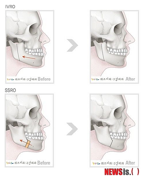 【서울=뉴시스헬스/뉴시스】 보통 양악수술에서 아래턱의 수술은 수직골절단술(IVRO) 이나 시상골절제술(SSRO) 두 가지 중 한 가지 방법으로 진행된다. (사진=위즈치과 제공) 조진성기자 cjs@newsishealth.com