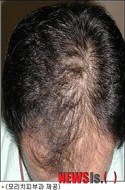 【서울=뉴시스헬스/뉴시스】 모낭염은 빨갛게 튀어나오거나 노란 고름으로 나타나는데 처음엔 가렵지만 증상이 심해지면 아프기도 하다. (사진=모리치피부과 제공) 조진성기자 cjs@newsishealth.com