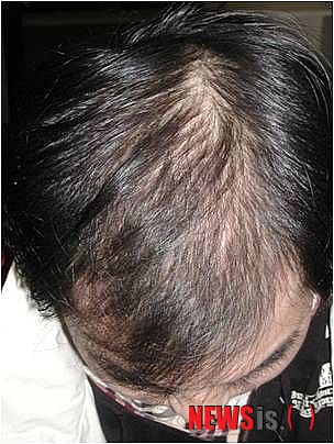 【서울=뉴시스헬스/뉴시스】 스트레스형 원형탈모 사례. (사진=모리치피부과 제공) 조진성기자 cjs@newsishealth.com