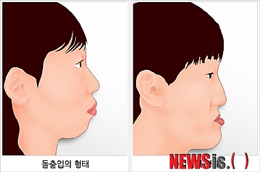 【서울=뉴시스헬스/뉴시스】 돌출입(왼쪽)과 주걱턱의 형태. (사진=오렌지성형외과 제공) 조진성기자 cjs@newsishealth.com