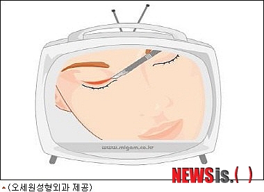 【서울=뉴시스헬스/뉴시스】 안검하수를 교정하기 위한 수술방법인 눈매교정은 눈의 검은자가 시원하게 보이지 않는 눈을 교정하는 목적으로도 사용되고 있다. (사진=오세원 성형외과 제공) 조진성기자 cjs@newsishealth.com