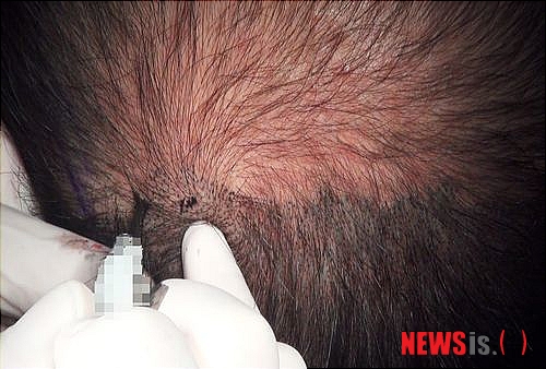 【서울=뉴시스헬스/뉴시스】 SMP란 두피에 직접 작용하는 반영구적 색소요법으로 여성의 정수리 탈모나 모발이식 후 빈도가 부족해 고민인 사람들에게 각광을 받고 있다. (사진=NHI뉴헤어 모발이식 센터 제공) 조진성기자 cjs@newsishealth.com