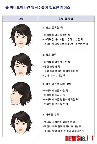 【서울=뉴시스헬스/뉴시스】 미니브이라인 앞턱수술이 필요한 사례. (사진=아이디병원 제공) 조진성기자 cjs@newsishealth.com