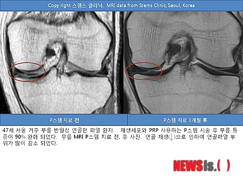 【서울=뉴시스】김정환 기자 = 자신의 치유 줄기세포(재생세포)와 혈소판 풍부혈장(PRP)을 이용, 손상된 무릎 관절의 연골을 재생시키는 ‘치유줄기세포 PRP 시술’의 임상효과가 입증됐다.&nbsp; 서울 청담동 스템스 관절재생 클리닉 박재우 박사는 “관절내시경 수술 후유증인 퇴행성 관절염과 슬개골 연골연화증 가능성을 염려한 반월상연골파열 환자가 자가 지방유래 줄기세포와 PRP 시술을 받았다. 4주가 지나자 무릎통증 등의 증상이 크게 완화됐고, 약 12주가 흐르면서 연골재생으로 반월상연골파열 부위가 많이 감소된 것이 MRI(자기공명영상) 상으로도 나타났다. 퇴행성관절염의 반월상연골판 연골재생 결과는 영국 학술지 (The Journal of Medical Case Reports http://www.jmedicalcasereports.com/content/5/1/296) 에 발표됐다”고 밝혔다.&nbsp; 주말에 등산, 축구, 농구 같은 야외활동을 하다 무릎을 삐끗한 후 ‘반월상연골파열’이라는 진단을 받는 환자들이 많다. 무릎 반월상연골판 연골은 반달모양의 물렁뼈로 외부 충격을 흡수하고 뼈와 뼈 사이의 윤활유 같은 역할을 한다. 심한 외부충격이 가해지거나 갑자기 넘어진 경우, 반월상연골파열이 되기 쉽다. 반월상연골파열 손상은 젋은층에서만 아주 심한 외상으로 발생한다고 생각하지만, 중장년층에서는 반월상연골판 연골 자체가 퇴행성 변화로 뻣뻣해져 가벼운 외적 충격으로도 손상되기 쉽다. 그러므로 갑작스런 무릎통증은 반월상연골파열일 가능성이 높다.&nbsp; 무릎 반월상연골판 연골이 파열되었을 때의 주 증상은 무릎을 구부릴 때, 쭈그리고 앉을 때, 계단을 내려갈 때 시큰거리면서 아프고 또 열이 나면서 붓기도 한다. 이 경우 먼저 MRI 같은 정밀검사로 반월상연골판 연골파열 손상의 정확한 부위와 정도를 파악해야 한다. 반월상연골파열은 조기에 치료가 이뤄지지 않으면 퇴행성관절염으로 이어질 수 있으므로 초기에 치료받는 것이 중요하다.&nbsp; 박 박사는 “반월상연골파열은 난치성 질환이지만 손상이 적고 증상이 없을 때는 자연치유가 가능하므로 먼저 파열된 반월상연골판의 위치와 정도 및 동반 인대손상 파악과 퇴행성관절염 여부도 평가돼야 한다”고 설명했다.&nbsp; 수술하지 않고 반월상연골파열을 치료하는 방법으로는 치유 줄기세포 또는 재생세포가 효과적이다. 반월상연골파열 부위에 치유줄기세포인 재생세포를 PRP와 함께 주입해 파열된 연골과 연골판을 재생하는 방법이다. 박 박사는 “한국특허를 취득하고 미국특허 출원 중인 치유줄기세포, PRP 시술은 인체 스스로 연골과 연골판을 재생하도록 유도해 무릎부위 절제나 수술 없이도 반월상연골판 연골을 재생시킬 수 있다”고 전했다.&nbsp; 치유줄기세포인 재생세포는 인체의 자가 치유재생세포로 골절, 연골, 근육, 피부손상 등의 외상 시 손상된 조직을 재생하는 인체의 치유줄기세포다. PRP는 여러 가지의 성장인자를 포함하고 있어 기존의 치유 줄기세포 또는 재생세포를 활성화시켜 콜라겐 생성 촉진으로 연골조직의 재생을 돕는다.&nbsp; 비수술 치료로 반월상연골 재생 시술을 받게 되면 3~6개월 후 증상이 80~90% 이상 호전될 수 있다. 반월상연골파열로 수술을 받을 경우 정상 연골이 제거돼 퇴행성관절염 유발을 촉진시킬 수 있는데 이때는 수술 전과 같이 통증이 나타나는 후유증 가능성 때문에 비수술적 치료를 충분히 고려하는 것이 현명하다.&nbsp; 또 반월상연골파열 치료 효과를 상승시키기 위해서 물리치료를 병행하는 것이 좋다. 무릎에 체중이 실리지 않도록 한 상태에서 무릎주변 근육과 인대를 강화하는 물리치료운동이 효과적이다. 고정식 자전거타기, 수영과 같이 무릎관절에 무리가 덜 가는 운동을 하는 것이 좋고 평소 쭈그려 앉는 자세 또는 양반다리는 피하도록 한다.&nbsp; ace@newsis.com