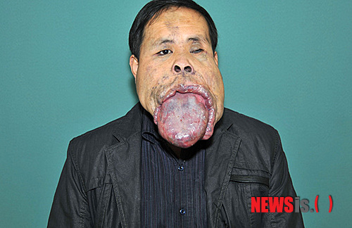 【서울=뉴시스】선천적 거설증으로 고통받고 있는 중국의 왕유핑(王有平·34)의 모습. 그의 혀는 일반인의 3~5배로 길이는 25㎝, 폭은 10㎝, 두께는 7㎝나 된다. (사진 출처=英 미러지 웹사이트)