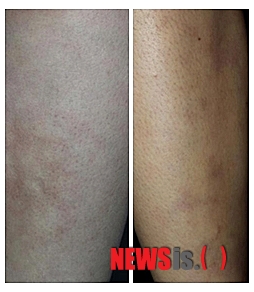 【서울=뉴시스헬스/뉴시스】 전기장판에 장시간 노출돼 열성홍반에 걸린 다리 피부. (사진=중앙대병원 제공) 서민지 기자 mingseo@newsishealth.com