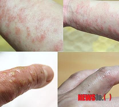 【서울=뉴시스】유희연 기자 = 동아당한의원에서는 천연광물질로 만든 파우더를 이용한 입욕 요법을 통해 독성물질을 땀으로 배출하도록 하고 있다.(사진=동아당한의원 제공)&nbsp; lovely_jh@newsis.com 