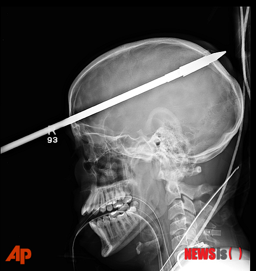 【마이애미=AP/뉴시스】미국 마이애미 대학 잭슨 메모리얼 병원이 제공한 사진으로 사고로 야세르 로페즈(16)의 머리를 관통한 작살이 보인다. 잭슨 메모리얼 병원의 라이더 외상 센터에 있는 로페즈는 19일(현지시간) 중태다. 병원 관계자들은 로페즈의 친구가 실수로 작살 총을 쐈다고 전했다. 로페즈는 지난 7일 작살이 이마에서부터 약 91㎝ 관통된 채 외상 센터로 이송됐다.