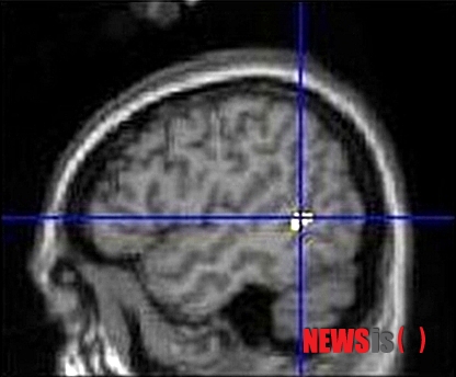 【청주=뉴시스】엄기찬 기자 = 충북대학교병원 정신건강의학과와 청주의료원 소아청소년정신과 연구팀은 25일 기능적 MRI(fMRI) 촬영으로 청소년 인터넷 중독자의 뇌에서 탈신체화 관련 뇌 부위의 활성화가 일반 청소년과 어떻게 다른지를 연구한 결과, 인터넷 중독 청소년의 뇌가 유체이탈 등의 탈신체화 자극에 매우 취약하다고 밝혔다. 사진은 연구팀이 발표한 좌뇌 측두엽-후두엽 연접부의 활성화 모습을 촬영한 사진. (사진=충북대병원 제공)&nbsp;&nbsp; photo@newsis.com 