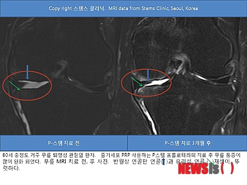 【서울=뉴시스】김정환 기자 = 과거 미국 NBC 뉴스는 "미국과 한국에서 많이 시술하는 관절 내시경 치료는 퇴행성 무릎관절염에 효과가 없을 수 있다"고 보도했다.(http://www.msnbc.msn.com/id/26644064/ns/health-arthritis/t/arthroscopic-knee-surgery-no-help-many)  미국에서는 매년 약 100만건의 관절내시경 수술이 이뤄지고 있다. 관절내시경으로 퇴행성관절염 환자들의 손상된 연골, 연골판과 떠 다니는 뼈 등을 제거하는 것이다. 그런데 물리치료와 소염제치료만 받은 퇴행성관절염 환자와 관절내시경 수술을 받은 환자의 상태가 큰 차이가 없다는 지적이다.  캐나다 웨스턴온타리오대에서 200여명의 중등·중증 퇴행성관절염 환자를 대상으로 한 연구가 바탕이 된 뉴스다. 이 연구에서 퇴행성관절염 환자의 절반은 소염제와 근육강화 치료를 받았고, 나머지 절반은 소염제·근육강화 치료와 더불어 관절내시경으로 손상된 연골과 연골판 부위를 다듬는 치료를 받았다.  치료 2년 후 이들 두 그룹 퇴행성관절염 환자들의 관절통증과 운동범위 결과가 비슷하게 나왔다. 이 연구의 부책임자 브라이언 페겐 박사는 관절내시경은 반월상 연골판 파열 부위가 크거나 경증 퇴행성관절염 환자에게만 유효할 가능성이 있다고 설명했다.  퇴행성관절염은 나이가 들어 생기는 난치병이다. 관절의 연골이 닳으면서 퇴행성 변화로 뼈의 변형과 함께 근육과 인대도 약해지면서 통증이 발생하는 관절 질환이다. 무릎 통증 탓에 일상적인 생활조차 힘들어질 수도 있다.  퇴행성관절염은 노년층에만 오는 것은 아니다. 잦은 외상 또는 과도한 운동으로 무릎 퇴행성관절염이 빨리 찾아 올 수도 있다.  퇴행성관절염은 초기에 발견하면 잘못된 습관과 비만 개선 등을 통해 증상을 완화하고 인대, 근육강화와 소염 진통제로 치료한다. 최근에는 줄기세포 프롤로 테라피로 연골 재생치료가 가능해졌다. 퇴행성관절염 초기와 중기에 약물치료, 물리치료와 더불어 줄기세포를 사용해 연골을 재생하는 것이다. 자가 지방줄기세포, 자가 골수줄기세포, 제대혈 줄기세포 등과 혈소판풍부혈장(PRP)을 사용하는 프롤로테라피 치료로 연골을 재생하면 퇴행성관절염으로 인한 무릎통증 완화와 함께 인공관절수술 시기를 지연시키는 것이 가능하다. 비수술적 요법이다.  서울 청담동 스템스 관절 클리닉 박재우 박사는 "줄기세포 PRP 프롤로테라피 시술은 손상된 연골조직을 증식시키므로 근본적인 치료로 통증이 완화된다. 하지만 노화로 인한 퇴행성관절염 자체가 완치되는 것은 아니므로 연골증식 치료 후에도 꾸준한 관리가 필요하다"고 설명했다.  박 박사는 지난해 영국의 전문학술지 '저널 오브 메디컬 케이스 리포트'(http://www.jmedicalcasereports.com/content/5/1/296)에 자가지방줄기세포 PRP 프롤로 테라피로 무릎 퇴행성관절염에서도 연골재생이 가능하다는 사실을 발표했다. 이 논문은 2011 영국 바이오메드센트럴의 최고 증례임상 논문상을 받았다. (http://www.biomedcentral.com/researchawards/award2011)  ace@newsis.com