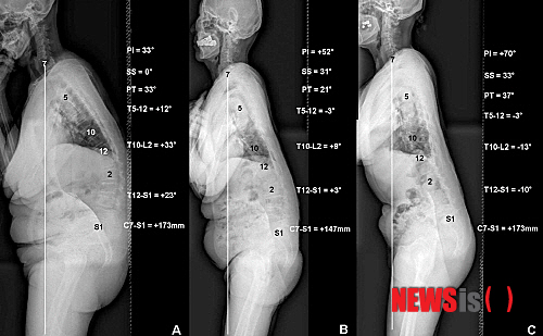 【서울=뉴시스헬스/뉴시스】골반입사각에 따라 퇴행성요추후만증의 추이가 달라지는 양상을 보인다. (사진=우리들병원 제공) 이새하 기자 lovesaeha@newsishealth.com 