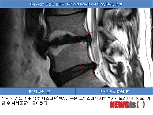 【서울=뉴시스】김정환 기자 = 허리 통증을 호소하는 남녀가 많다. 나이가 들면서 퇴행성 관절염의 일종인 추간판 디스크 탈출증, 척추관 협착증, 척추 전방 전위증 등으로 인한 허리 통증이다. 젊은층에서는 스포츠 인구 증가와 더불어 직장인과 학생들의 잘못된 자세, 비만, 편리해진 생활로 인한 운동부족 등으로 척추 디스크 질환이 증가하고 있다. 국민의 80%가 일생에 한 번 이상 요통, 허리통증을 느끼고, 그 가운데 10~20%는 허리디스크 환자일만큼 척추 디스크 질환은 흔하다. 일반적으로 척추 추간판 탈출증을 허리 '디스크'라고 한다. 하지만 디스크는 척추 뼈 사이에 있는 연골판을 일컫는 말이다. 척추 뼈 사이의 디스크 또는 연골판은 내부, 외부로 나뉜다. 내부는 물렁한 연골(nucleus pulposus)로 형성돼 있고, 외부는 단단한 연골(annulus fibrosus)로 만들어져 있다. 이 디스크는 척추 뼈 사이에서 스프링 또는 쿠션 역할을 한다. 과도한 힘 또는 노화 현상으로 외부의 단단한 연골이 파열되면 내부의 물렁한 연골이 빠져 나와 요통, 허리통증을 유발한다. 빠져 나온 물렁한 연골이 척추 신경을 누르면 허리통증이 팔 또는 다리로 내려가는데 이 것을 디스크라고 한다. 척추 디스크는 수술 없이 보존적인 치료 방법만으로 좋아질 수 있다. 호전되지 않을 경우, 수술로 연골 파열 부분을 절제해야 하지만 필요한 연골을 잘라 내는 것이기 때문에 후유증으로 허리 관절에 퇴행성관절염이 빨리 올 수 있다. 요통, 허리통증은 단순 통증에 그치지 않는다. 생활 리듬을 현저히 흩트린다. 사회활동이 왕성한 사람들에게 나타나면 사회적 손실도 크다. 요통의 원인으로 젊은층에서는 척추 추간판탈출증, 디스크 또는 인대 손상이 일반적이지만 노년층에서는 척추디스크 외에도 척추 압박골절 또는 척추관 협착증, 척추 전방전위증 등이 흔하다. 요통 치료는 비수술적 요법과 수술적 방법으로 크게 나눌 수 있다. 비수술적 요법은 자생치유가 되도록 최대한 돕는 것이다. 비수술적 요법으로 치료가 어려운 경우는 수술을 해야하나 수술 이후의 부작용도 고려해야 한다. 비수술적 요통, 허리통증 치료 요법으로 지방줄기세포가 도입됐다. 자신의 복부 내 지방줄기세포와 혈액 속 혈소판풍부혈장(PRP)을 이용해 손상된 척추 디스크 연골을 재생시키는 치료법이다. 서울 청담동 스템스 줄기세포 클리닉의 박재우 박사는 2009년부터 최근까지 척추 관절 디스크, 퇴행성관절염 또는 반월상 연골파열, 대퇴골두 무혈성 괴사 등을 앓는 500여명의 환자를 대상으로 복부와 옆구리 엉덩이 등에서 지방을 뽑아내 지방줄기세포를 추출한 뒤 혈액 속의 PRP와 함께 환부에 주사해 연골조직 또는 뼈조직 재생을 유도하는 치료법을 시도했다. 박 원장은 "이 치료는 자신의 세포를 사용하기 때문에 면역거부 반응이 없을 뿐만 아니라 환부에서 성체줄기세포가 연골세포로 분화돼 손상된 관절의 연골조직을 재생시키므로 기존의 보존적 치료보다 훨씬 결과가 좋다"고 강조했다. 성체줄기세포는 복부 지방 또는 골수에서 간단히 채취 가능하다. 채취한 성체줄기세포는 뼈, 연골, 근육, 인대, 핏줄 등을 재생시켜 요통을 근본적으로 치료할 수 있도록 한다. 자가 지방에서 채취한 지방줄기세포는 자가혈 PRP를 같이 주입하므로 연골재생 효과 및 인대 강화에도 효과적이다. 박 원장은 "너무 말라 지방이 거의 없는 경우가 아니라면 나이가 많아도 지방줄기세포 시술을 받을 수 있다"고 전했다. 이 치료법은 박 박사가 세계 최초로 개발, 한국특허(10-1038616)를 획득하고 또 영국 의학학술지 '저널 오브 메디컬 케이스 리포트'(http://www.jmedicalcasereports.com/content/5/1/296)에 발표했다. 이 논문은 2011년 영국 바이오메드센트럴의 최고 증례임상 논문상을 받기도 했다. (http://www.biomedcentral.com/researchawards/award2011) 박 박사는 "지방줄기세포 PRP 연골재생 치료는 손상된 연골조직을 재생해 통증을 완화하는 치료다. 퇴행성관절염, 척추 디스크 등 병변 자체가 젊어지는 것은 아니므로 연골재생 치료 후에도 꾸준한 관리가 필요하다"고 지적했다. ace@newsis.com