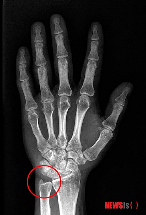 【서울=뉴시스】척골충돌증후군
