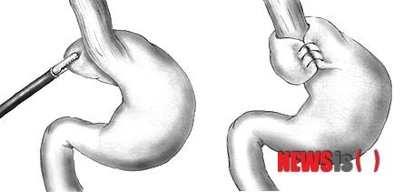 【서울=뉴시스헬스/뉴시스】 역류성 식도염을 치료하기 위한 복강경 위저추벽성형술(Laparoscopic Nissen fundoplication) 이미지. (사진=중앙대학교병원 제공) 이새하 기자 lovesaeha@newsishealth.com