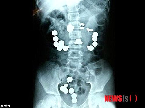 【서울=뉴시스】러시아의 병원에서 공개한 엑스레이 사진으로 한 아이가 삼킨 42개의 냉장고 자석의 일부. 아이는 수술을 받은 후 안정을 취하고 있다.(사진출처: 데일리미러) 