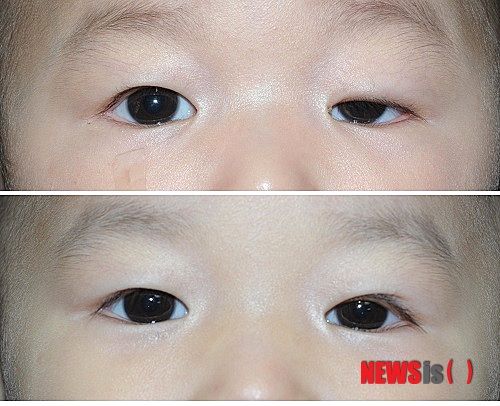 【서울=뉴시스헬스/뉴시스】 선천성안검하수 수술 전(위)과 수술 후. (사진=세브란스병원 제공) 김민서 기자 kms@newsishealth.com