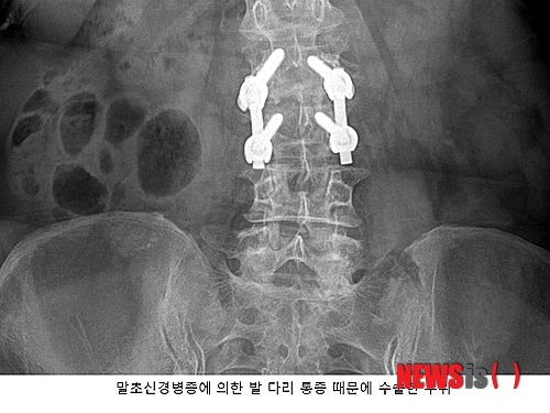 【서울=뉴시스】김정환 기자 = 신모(56·여)씨는 만성 발·다리 저림 증상과 작열 통증에 시달렸다. 여러 병원을 다녔으나 확실한 원인을 찾지 못했다. 허리 척추 디스크 협착증에 의한 신경통 가능성 진단을 받았을 뿐이다.&nbsp; 발·다리 저림 증상과 작열통증이 극심해졌고 결국 척추 디스크 수술을 받았다. 하지만 수술 후에도 발·다리 통증은 개선되지 않았다. 그러다 스템스 줄기세포 재생의학 클리닉에서 ‘말초신경병증’이라는 진단을 받고 신경강화주사 후 저림 증상과 작열통증이 호전되기에 이르렀다.&nbsp;&nbsp; 말초신경은 척추에서 나온 모든 신경을 일컫는 말이다. 말초신경은 오장육부를 포함한 손, 발, 다리 등 온몸에 퍼져 있다. 이러한 신경에 병적인 변화가 오는 것을 말초신경병증이라고 한다. 그러므로 말초신경병증 질환의 주 증상은 어느 신경에 병적인 변화가 왔는지에 따라 다르다. 저린 작열통증, 시리거나 화끈거림, 근육 수축과 떨림, 배변이상과 성기능장애 등을 초래할 수도 있다.&nbsp; 말초신경병증은 크게 다발성신경병증, 단발성신경병증, 다발성 홑신경염, 자율신경병증 질환으로 나눌 수 있다. 이 중 제일 흔한 것이 다발성 신경병증이다. 다발성신경병증은 발·다리 저림이 주 증상이다. 이 같은 증상은 허리 척추 신경 협착증 증상과 비슷하게 느낄 수도 있다. 하지만 척추 신경 협착증에 의한 다리 통증이 주로 한 쪽인 반면, 말초신경병증 질환 증상은 양쪽 발과 다리에 온다.&nbsp; 다발성 말초신경병증의 주 증상은 허리 척추 협착증에 의한 신경통과 비슷하게 발과 다리가 저리거나 따끔거림, 작열 통증, 무감각 또는 감각저하, 시리거나 화끈거리는 증상, 벌레가 기어 다니는 느낌, 전기 감전 느낌이나 바늘에 찔리는 느낌 등이 있다. 허리 척추 디스크 협착증은 물론 족저근막염, 퇴행성관절염을 포함한 발, 발목, 무릎 관절염으로 착각할 수 있는 증상들이다.&nbsp; 말초신경병증 질환의 원인은 당뇨병, 술, 환경요소, 혈액순환 장애, 유전, 비타민 부족, 발·다리 부종 등에 의한 만성적 신경압박, 항암 치료, 약물 부작용 등을 손꼽을 수 있다.&nbsp; 말초신경병증 질환은 원인이 여러 가지이고 증상이 애매하므로 확실한 진단이 쉽지 않다. 따라서 의사의 문진과 진찰이 말초신경병증 진단에 가장 중요하다. 근전도검사와 신경조직검사를 할 수도 있으나 초기에는 검사 결과가 정상으로 나오는 경우가 많다. 확실한 진단이 어려운만큼 치료도 쉽지 않다.&nbsp; 미국에서는 말초신경병증에 신경강화주사를 많이 사용하고 있다. 신경강화주사는 손상된 신경이 다시 자가 치유되도록 도와주는 역할을 한다. 원인 치료인 셈이다. 신경강화주사로 원인 치료가 돼 저린 증상 과 작열통증이 좋아지는 것이다. 스템스 줄기세포 재생의학 클리닉 박재우 박사는 “초기에 증상이 경미하다고 무시하고 방치하면 신경손상이 더욱 악화돼 치료가 더욱 힘들어진다”며 “신경은 한 번 손상되면 재생이 힘들기 때문에 초기에 치료해 신경손상 악화를 방지하는 것이 최선”이라고 강조했다.&nbsp; ace@newsis.com&nbsp; 