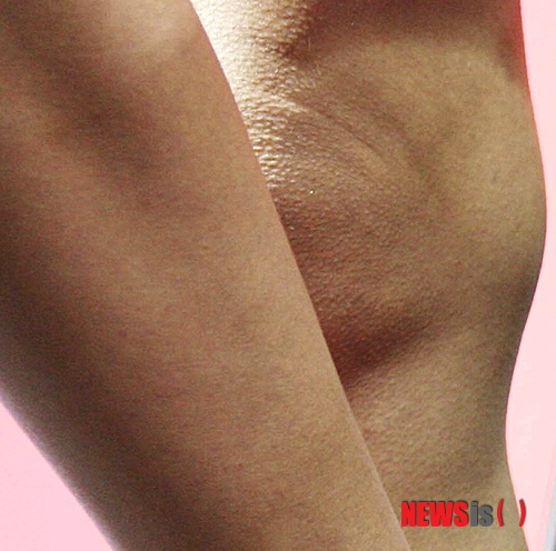 【서울=뉴시스】김정환 기자 = 실내에서 트레드밀(러닝머신)으로 운동하는 남녀가 많다. 하지만 무리한 트레드밀 운동은 무릎 반월상연골파열 질환의 원인이 될 수 있다.&nbsp; 스템스 풋 클리닉 김승현 박사(미국 발·다리 전문의)는 “무릎이 바닥을 디딜 준비가 안 됐을 때 트레드밀 자체가 돌면서 발을 친다”면서 “무릎의 외부충격을 흡수하는 반월상연골판에 지속적인 충격을 주는 구조”라고 지적했다.&nbsp; 무릎 반월상연골판 연골은 반달모양의 섬유성 연골로 외부 충격을 흡수하고 뼈와 뼈 사이의 유리성 연골을 보호하며 무릎관절 내의 윤활유을 분비하는 역할을 한다. 이러한 연골에 심한 외부충격이 가해지거나 갑자기 넘어진 경우, 또는 심한 운동 등으로 섬유성 연골이 파열된 경우를 반월상연골파열이라고 한다.&nbsp;&nbsp; 반월상 연골손상은 젋은층에서만 외상으로 발생한다고 생각하지만, 퇴행성관절염 질환이 시작되는 중장년층에서도 반월상연골판 연골 자체가 뻣뻣해져 가벼운 외적 충격으로도 손상되기 쉽다.&nbsp; 무릎 반월상연골파열 질환의 주 증상은 무릎을 구부릴 때, 쭈그리고 앉을 때, 계단을 내려갈 때 시큰거리면서 아프고 또 열이 나면서 붓기도 한다. 이 경우 먼저 자기공명영상법(MRI) 같은 정밀검사로 반월상연골판 연골파열 손상의 정확한 부위와 정도를 파악해야 한다. 반월상연골파열은 조기에 치료가 이뤄지지 않으면 퇴행성관절염으로 이어질 수 있으므로 초기에 치료받는 것이 중요하다.&nbsp;&nbsp; 스템스 줄기세포 클리닉 박재우 박사는 “반월상연골파열 손상이 적을 때는 자연치유가 가능하므로 먼저 약 2주 동안 소염제 및 휴식을 취하고 증상이 지속 될 경우는 반월상연골파열 위치와 정도 및 인대손상 파악과 퇴행성관절염 여부도 평가해야 한다”고 설명했다.&nbsp; 반월상연골파열 치료에는 수술적인 방법과 비수술적인 방법이 있다. 수술적인 방법으로는 관절내시경 연골절제술이 있고, 비수술적 방법으로는 줄기세포 또는 지방줄기세포 혈소판 풍부혈장(PRP) 혼합 연골재생 시술이 있다. 관절내시경 연골절제술은 필요한 연골을 절제하기 때문에 퇴행성 관절염이 빨리 온다는 단점이 있고 또 연골절제 부분이 과다할 경우 슬개골 연골연화증이 생길 수도 있다. 반면, 지방줄기세포 PRP 혼합 연골재생 시술은 이러한 부작용이 없다. 박 박사는 “한국특허를 취득하고 미국특허 출원 중인 지방줄기세포 PRP 혼합 연골재생 시술은 관절내시경 연골절제 수술과 달리 퇴행성관절염 및 슬개골 연골연화증 부작용이 없다는 것이 큰 장점”이라고 강조했다.&nbsp; 김승현 발·다리 전문의는 “더위 탓에 실내에서 운동을 해야 한다면 트레드밀 대신 다른 운동기구를 권한다”고 전했다.&nbsp; ace@newsis.com 