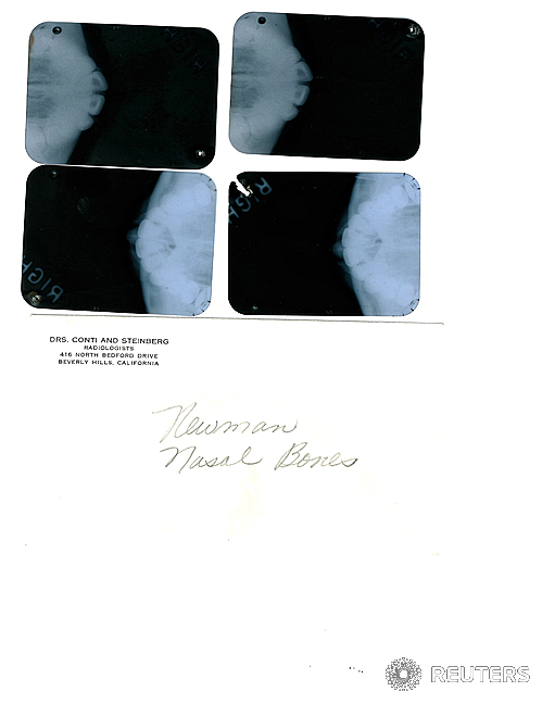 【베벌리힐스=로이터/뉴시스】미국 경매회사 줄리언스 옥션스가 7일(현지시간) 캘리포니아주(州) 베벌리힐스에서 공개한 마릴린 먼로의 X선 사진들. 줄리언스 옥션스는 8일 먼로가 받은 성형수술에 대한 X선 사진들과 진료기록이 다음달 경매에 나올 것이라고 밝혔다. 성형 전문의 마이클 거딘이 작성한 이 진료기록으로 1950년대 먼로가 미용을 목적으로 성형수술을 받았다는 추측이 사실임이 확인됐다. 2013.10.12