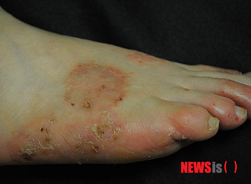 【서울=뉴시스】유희연 기자 = 11일 고운결한의원 측에 따르면 한포진은 스트레스나 불규칙한 생활습관, 계절 변화 등의 영향으로 나타난다. 특히 니켈, 크롬, 코발트 등의 금속물을 자주 접촉하는 직업군에서 발병률이 높다. 2013.10.11. (사진=고운결한의원 제공) lovely_jh@newsis.com