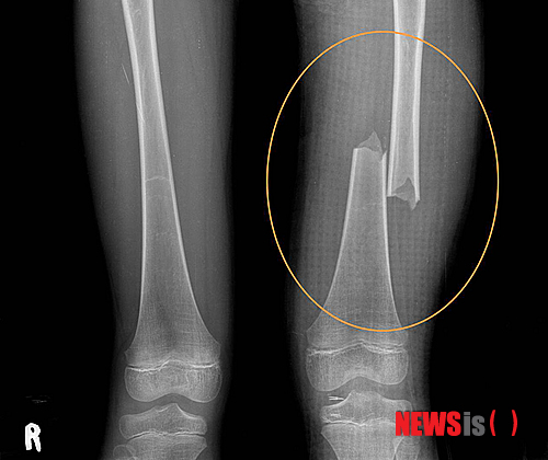【울산=뉴시스】장지승 기자 = 계모의 폭행에 의해 사망한 8살 의붓딸의 허벅지 엑스레이 사진을 4일 경찰이 공개했다. 계모 박씨는 지난달 24일 울산 울주군 범서읍 자신의 아파트에서 의붓딸의 머리와 가슴, 허리 등을 수차례 때려 숨지게 한 혐의로 구속됐다. 2013.11.04. (사진=울주경찰서 제공)&nbsp; jjs@newsis.com
