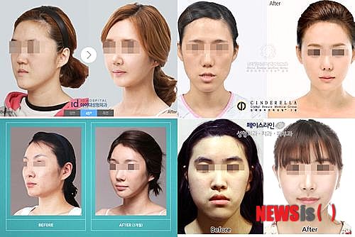 【서울=뉴시스헬스/뉴시스】 26일 강남 대형 성형외과들도 과장광고에 해당하는 성형 전후 사진 게재해 논란이 되고 있다. 아이디병원(사진 좌측 상단부터 시계방향 순), 신데렐라성형외과, 페이스라인성형외과, 원진성형외과 성형 전후 사진 모습. (각 성형외과 홈페이지 캡처) 최성훈 기자 cshoon@newsishealth.com