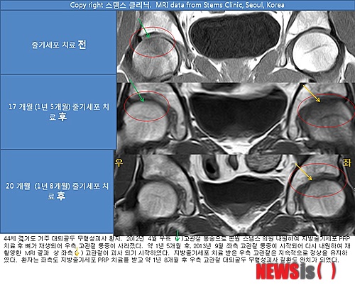 【서울=뉴시스】오제일 기자 = 경기도에 거주하는 황모(44)씨는 오른쪽 고관절 대퇴골두 무혈성 괴사증으로 인한 엉덩이 관절통증으로 고생하고 있었다. 복용하는 소염진통제도 고관절 통증에는 도움이 되지 못했다. 나이 때문에 수술을 받을 수도 없었다.&nbsp;&nbsp; kafka@newsis.com