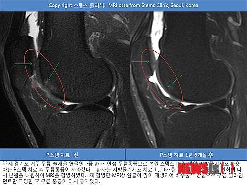 【서울=뉴시스】김태은 기자 = 슬개골 연골연화증 및 슬개골 퇴행성관절염은 반월상연골파열 수술, 오(O)자 다리, 안짱다리 등으로 인해 무릎의 얼라인멑트 균형이 바뀌면서 연골에 손상이 생기는 질환이다.&nbsp; tekim@newsis.com