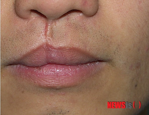 【서울=뉴시스】민기홍 기자 = 구순열흉터 치료. 2014.04.10. (사진=안성열 피부과 제공)