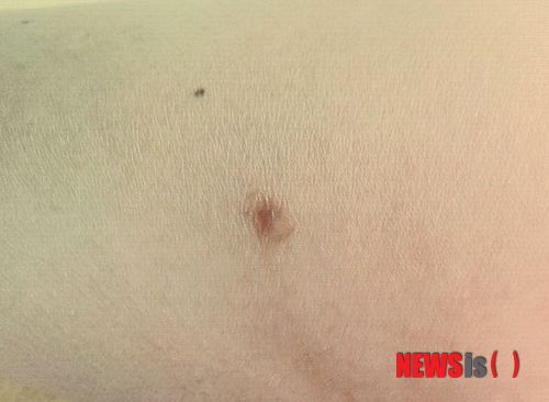 【서울=뉴시스헬스/뉴시스】 여드름과 증상이 비슷한 모낭염은 원인과 관리법이 전혀 다르기 때문에 미리 알아두고 대처하는 것이 현명하다. 박소라 기자 imsorapark@newsishealth.com