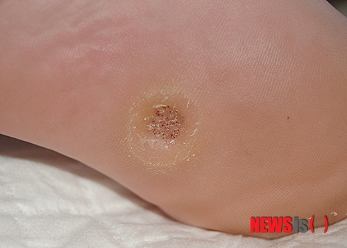 【서울=뉴시스】오제일 기자 = 바이러스로 발생하는 대표적인 피부질환이 사마귀다. 인유두종바이러스(HPV)에 의해 신체 모든 부위에 남녀노소를 가리지 않고 발생한다. 면역력이 약해진 생태에서 쉽게 퍼질 수 있고 타인에게 전염시킬 수 있기 때문에 빨리 치료를 받는 것이 좋다.&nbsp; 단체 생활을 하는 아이들은 면역력이 성인보다 떨어지기 때문에 더 주의해야 한다. 사마귀가 발생한 것도 모르고 아이들끼리 서로 장난치고 만지면서 전염되는 경우가 많다. 보호자가 유심히 관찰하지 않으면 몸에 생긴 사마귀를 숨기고 말을 하지 않을 수도 있어 단체 생활을 하는 아이들은 항상 관심을 가지고 지켜봐야 한다. 작은 변화라도 주의 깊게 살펴서 발생 초기 단계에서 사마귀를 치료하는 것이 좋다.&nbsp; 아이들은 사마귀를 손톱으로 뜯거나, 치아로 물어뜯고, 자주 긁는다. 자칫 잘못하면 입 주변이나 손톱 주위 등 주변 피부로 사마귀가 더 확산될 수 있다. 손톱 주위에 생긴 사마귀, 즉 조갑주위 사마귀는 조갑기질을 파괴해 손톱의 기형을 유발하므로 각별한 주의가 필요하다.&nbsp; 냉동요법과 약물요법, 주사요법, 레이저 요법 등으로 치료한다. 액체 질소를 이용해 사마귀 병변을 냉동시켜 치료하는 냉동요법이 보편적으로 많이 사용된다. 탄산가스 레이저 또는 퍼팩타 레이저를 통한 레이저 시술법도 사용된다. 사마귀가 아주 많고 큰 경우는 DNCB를 이용한 면역요법도 사용할 수 있고 사마귀가 크고 수가 적을 때는 사마귀 부위에 약제를 직접 주사하는 방법도 있다.&nbsp; 사마귀 치료 방법 중 펄스 다이 레이저의 치료법은 선택적인 광열분해의 원리로 정상 피부에는 아무 지장 없이 치료하고자 하는 사마귀 병변 부위만을 파괴해 치료할 수 있다. 사마귀의 위치나 크기, 숫자, 2차 세균감염 여부, 그리고 개인에 따라 달라지지만 2~3회 치료로 사마귀가 좋아지는 경우가 많고 다른 치료에 비해 통증이 적어 쉽게 접근할 수 있는 장점이 있다.&nbsp; 귀가 후에는 꼭 손과 발을 깨끗하게 씻는 습관을 길러야 한다. 사마귀가 발생했을 때는 병원에서 치료를 받는 것을 당연하게 생각하는 것이 필요하다. 자칫 발바닥 사마귀를 티눈으로 오인해 자가 치료를 하면서 더 번지는 경우가 많다. 사마귀와 티눈 등이 생기면 자가 치료를 우선하지 말고 전문의 진료를 우선하는 생각을 가져야 한다.&nbsp; 듀오피부과 홍남수 원장은 "전염성이 있는 사마귀는 본인을 위한 치료뿐 아니라 타인을 배려하는 마음으로 빨리 치료를 받는 것이 좋다. 한곳에 발생한 사마귀가 몸 여러 곳으로 퍼지면 치료할 때의 통증이 심해 치료를 기피하게 되고 사마귀가 더 많이 생길 수 있는 상황이 될 수 있다"고 지적했다.&nbsp; kafka@newsis.com