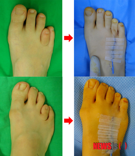 【서울=뉴시스】민기홍 기자 = 단지증 수술 전·후. 2014.05.26. (사진=새움병원 제공) 