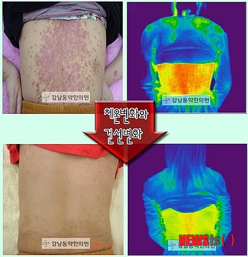 【서울=뉴시스】민기홍 기자 = 건선 치료. 2014.06.18. (사진=강남동약한의원 제공)