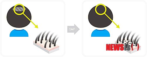 【서울=뉴시스】민기홍 기자 = 탈모 해결. 2014.07.16. (사진=NHI뉴헤어 모발이식센터 제공) 