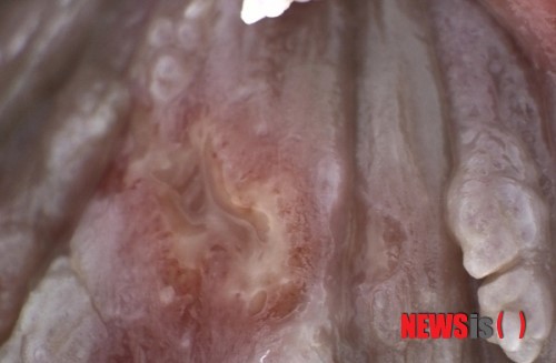 【서울=뉴시스】민기홍 기자 = 곤지름. 2014.07.17. (사진=보명한의원 제공)