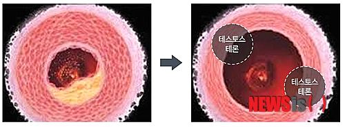 【서울=뉴시스】유희연 기자 = 식품의학연구소인 ㈜알앤씨바이오(RNCBIO)에서 남성 갱년기를 해결할 수 있는 3단계 솔루션을 개발해 주목받고 있다. 사진은 테스토스테론이 혈관장애를 개선해 혈관이 깨끗해진 모습이다. lovely_jh@newsis.com
