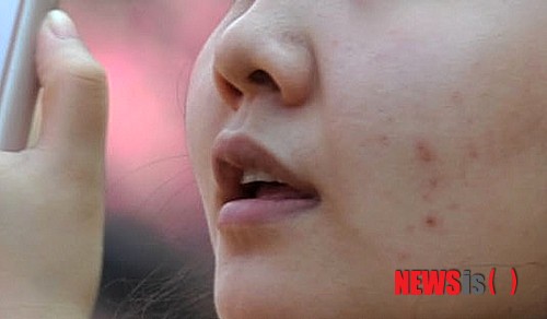 【서울=뉴시스】유희연 기자 = 여드름은 유전적으로 각질이 생성되는데 비해 원활히 탈락하지 않아 모공이 막혀 생기는 질환이다. 여기에 피지 및 부산물들이 쌓여 여드름 균이 이를 먹고 자라면서 점차 염증이 확대된다. 이를 방치해 염증이 심해지면 모공 벽이 파괴되고 점차 주변 조직으로 확산돼 붉게 충혈되고 통증까지 나타날 수 있다. lovely_jh@newsis.com