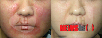 【서울=뉴시스】유희연 기자 = 안면지루성피부염을 치료하려면 지루성피부염 원인을 먼저 잘 아는 것이 큰 도움이 된다. 경희샘한의원 측에 따르면 지루성피부염원인은 몸속의 과도한 열이 뭉쳐있는 현상인 열대사장애 때문이다. 우리 몸속의 열이 제대로 순환하지 않고 한 곳에 뭉쳐있어 발병한다.&nbsp; lovely_jh@newsis.com