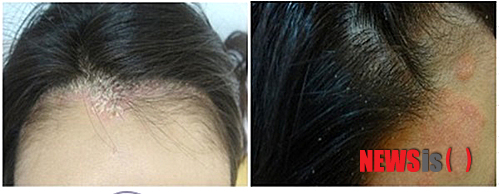 【서울=뉴시스】유희연 기자 = 가을철에 발생한 두피 건선피부염을 방치하면 탈모로 진행될 위험이 크다.&nbsp; lovely_jh@newsis.com