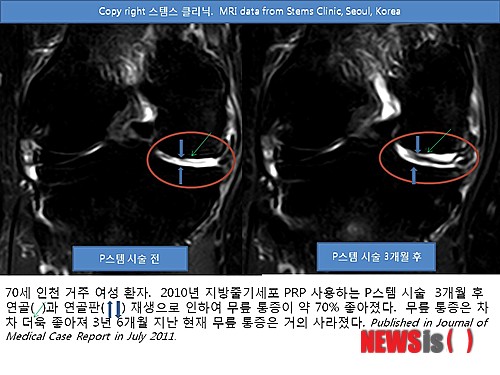 【서울=뉴시스】유희연 기자 = 스템스 줄기세포 클리닉 박재우 박사가 필리핀 마닐라의 스템 케어 인스티튜트(http://www.stemcareinstitute.com) 정형외과로 자가 지방줄기세포·PRP 연골재생술 기술을 이전했다.&nbsp; lovely_jh@newsis.com 