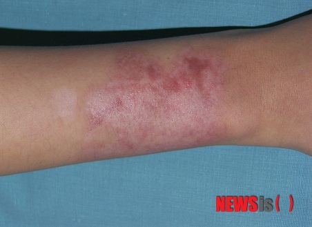 【서울=뉴시스】유희연 기자 = 화상흉터는 피부 구축이 있을 경우 '다발성Z 성형술'로, 구축이 없다면 '흉터레이저'로 주변의 정상피부와 최대한 근접한 상태로 개선할 수 있다.&nbsp;&nbsp; lovely_jh@newsis.com&nbsp; 