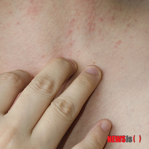 【서울=뉴시스】유희연 기자 = 호서펩티드연구소가 개발한 'HG1'은 동해안에서 살고 있는 비단멍게의 체액을 이용, 가공한 항균펩타이드다. 피부보습은 물론 아토피 치료에 큰 도움을 주는 것으로 알려져 있다.&nbsp; lovely_jh@newsis.com 