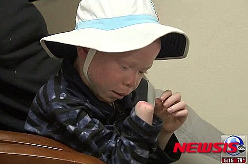 【서울=뉴시스】6살된 바라카는 하얀피부를 가진 흑인 '알비노'다. 바라카는 탄자니아에서 납치돼 오른팔을 잃었다. 아프리카에서 알비노의 신체 일부는 '행운의 상징'으로 여겨져 알비노의 납치 살해가 심각한 사회문제가 되고 있다. 바라카는 다른 4명의 탄자니아 알비노 어린이들고 함께 지난 17일(현지시간) 한 자선단체의 도움으로 미국 필라델피아의 슈라이너 병원에 도착했다. 2015.06.19. (사진출처: 영국 데일리메일)