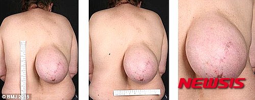 【서울=뉴시스】 최근 아일랜드 더블린에 거주하는 한 40대 여성이 자신의 등에서 자라고 있는 '가슴' 때문에 병원을 찾았다. 그러나 그것은 가슴이 아니고 '종양'으로 진단됐다. 그녀는 곧 종양 제거 수술을 받을 예정이다. (사진출처:데일리메일) 2015.09.11.