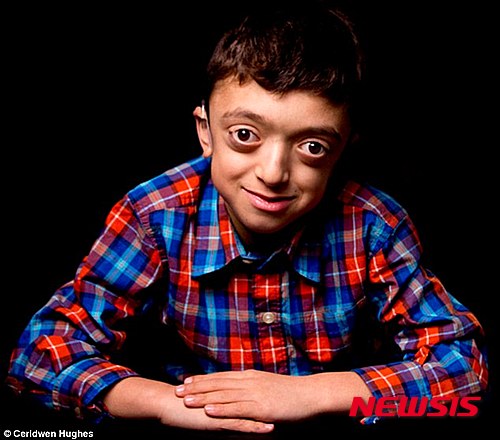 【서울=뉴시스】크루존 증후군을 앓고 있는 매튜.(사진출처: 데일리메일) 2015.11.27.